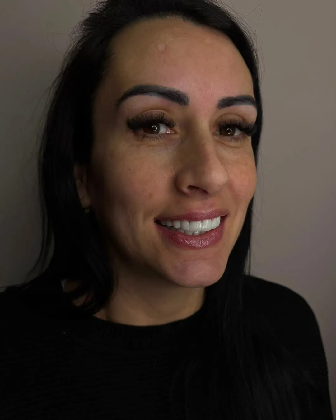 Paciente real da Três Odontologia sorrindo com facetas e lentes em resina