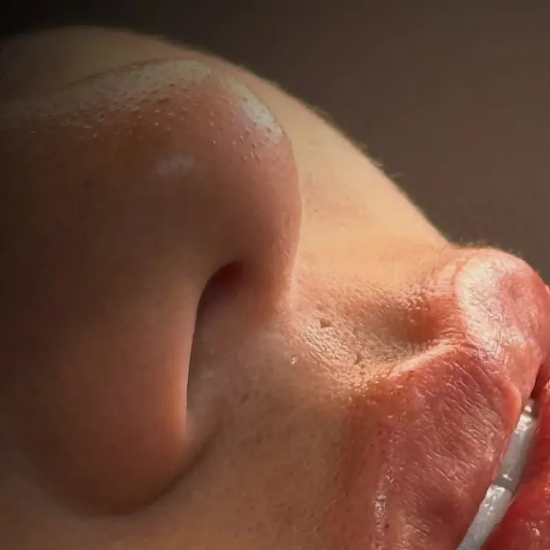 Registro real de um procedimento de harmonização facial na Três Odontologia